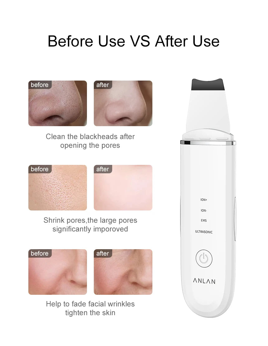 ANLAN Ultrasonic Skin Scrubber – 4-Mode Facial Pore Cleansing Spatula with Microcurrent Lifting