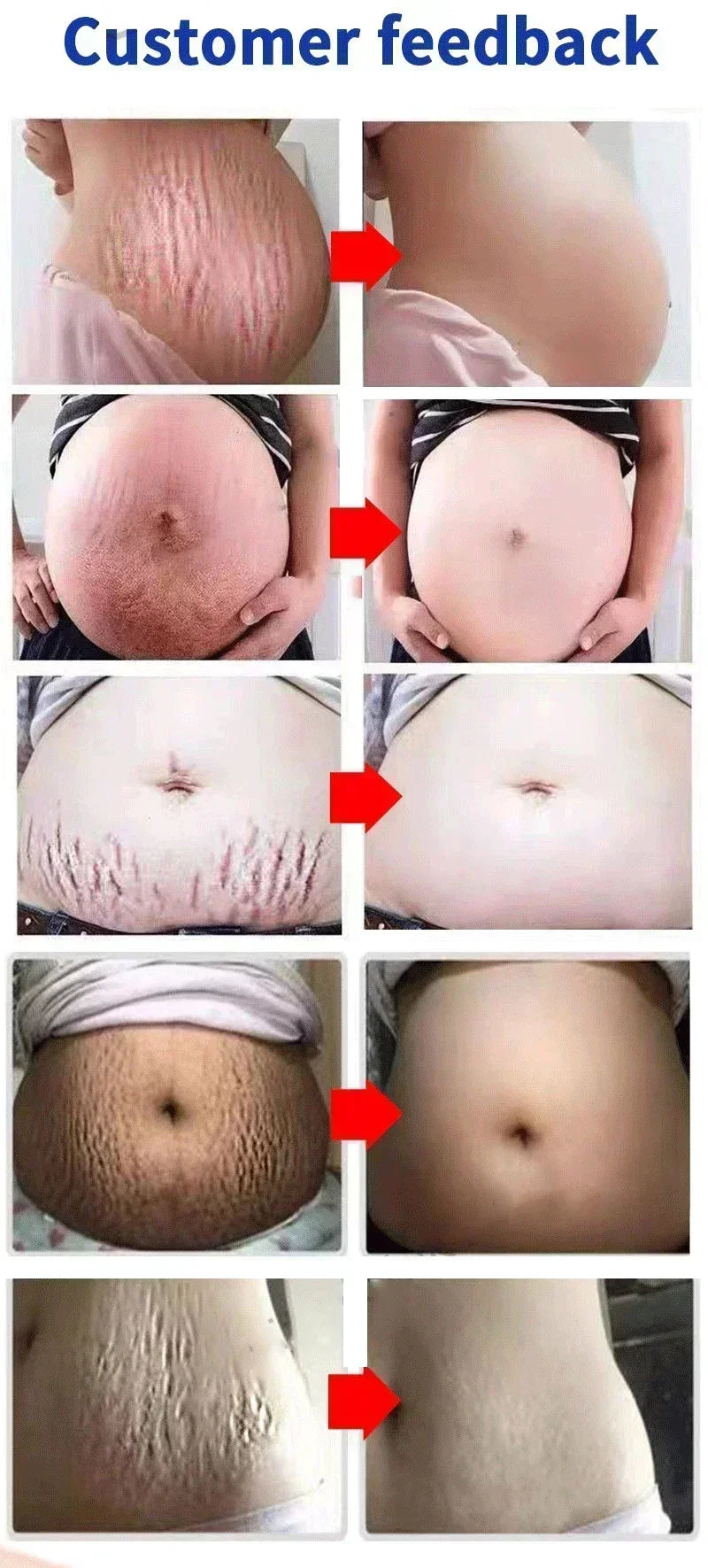 Stretch Marks Treatment & Repair Body Oil — Anti-Wrinkle Skin Care Oil for Maternity & Postpartum