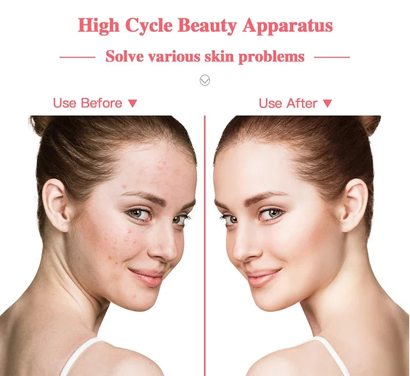 High Frequency Facial Wand – Acne Treatment, Skin Rejuvenation & Anti-Aging Device with 4 Glass Tubes