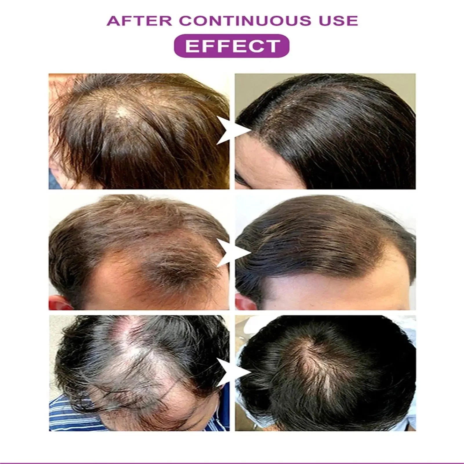 Black Rice Fast Hair Growth Serum Spray for Men Women Anti-loss Hair Regrowth Essential Oil Scalp Treatment Hair Care Products