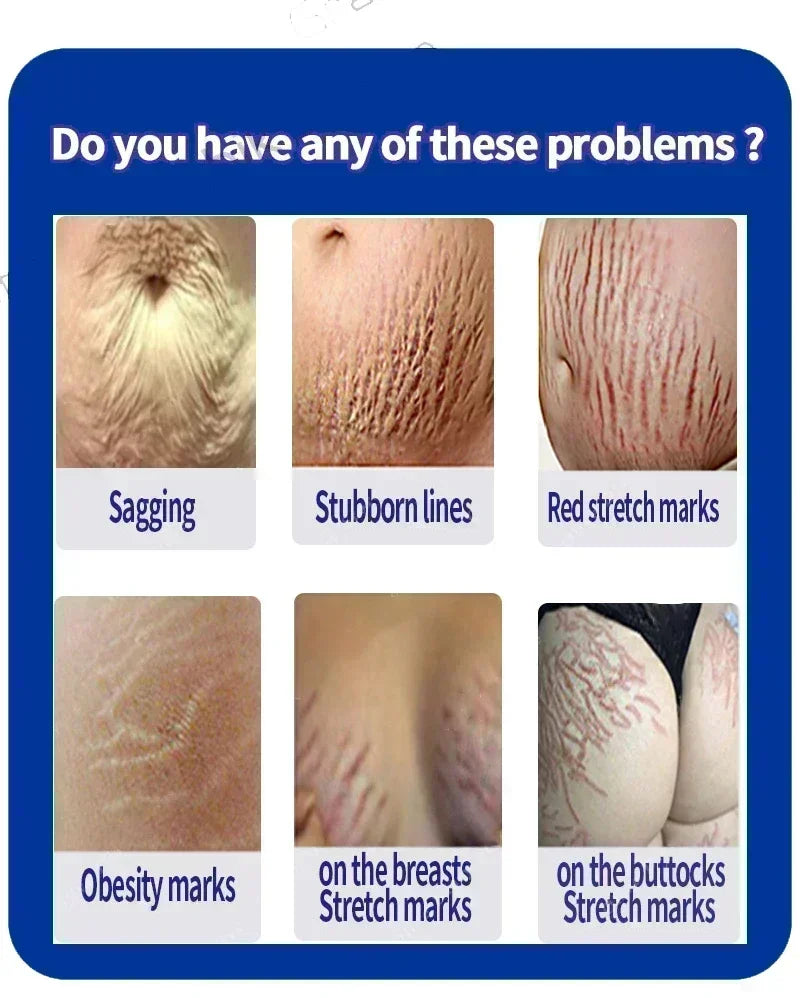 Stretch Marks Treatment & Repair Body Oil — Anti-Wrinkle Skin Care Oil for Maternity & Postpartum