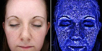 Wood's Lamp UV Skin Analyzer – 365nm UV Light Skin Scanner with 3x Magnifying Lens for Home & Salon Use