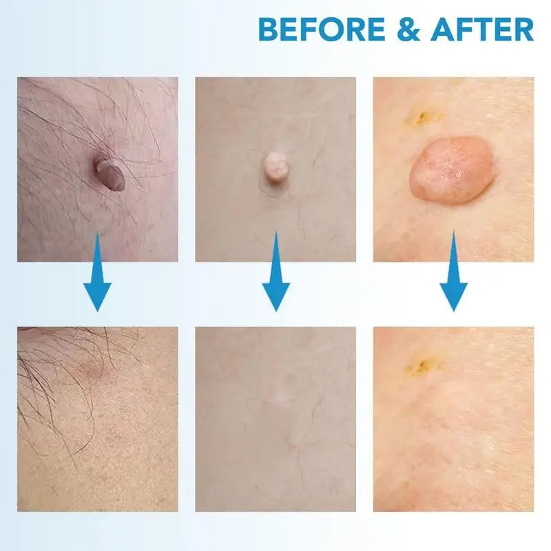 Skin Tag Remover Pen Kit – Painless Removal for 4mm–9mm Skin Tags