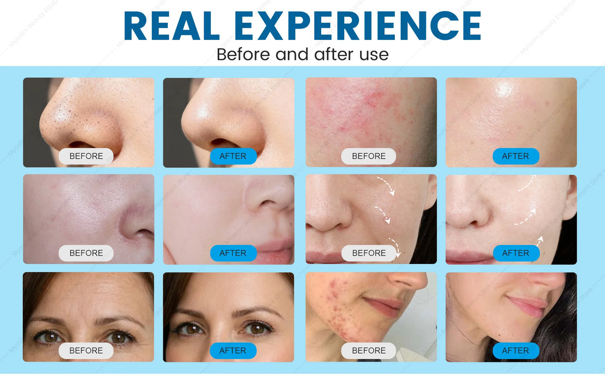 MYOSLIM 7-in-1 Smart Skin Analysis & Beauty Machine – Blackhead Remover, Wrinkle Reduction & Skin Tester