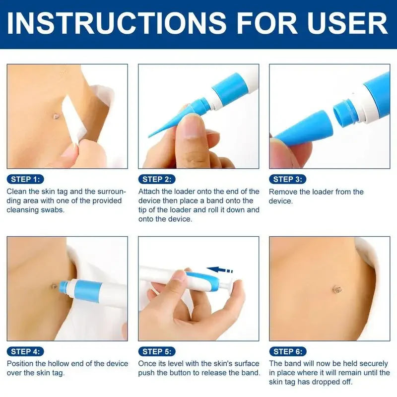 Skin Tag Remover Pen Kit – Painless Removal for 4mm–9mm Skin Tags