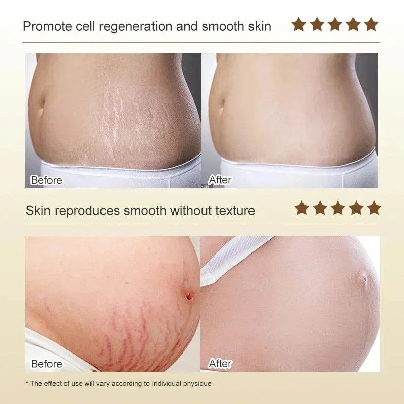 Stretch Marks Permanent Removal Cream — Repair, Firming & Skin Elasticity Body Cream 40g