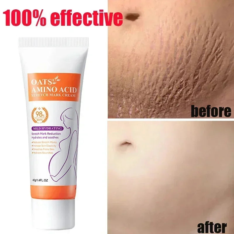 Stretch Marks Permanent Removal Cream — Repair, Firming & Skin Elasticity Body Cream 40g
