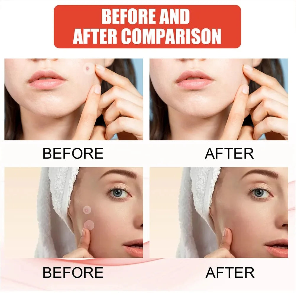 Invisible Acne Pimple Patch — Concealer Spot Stickers for Clear Skin