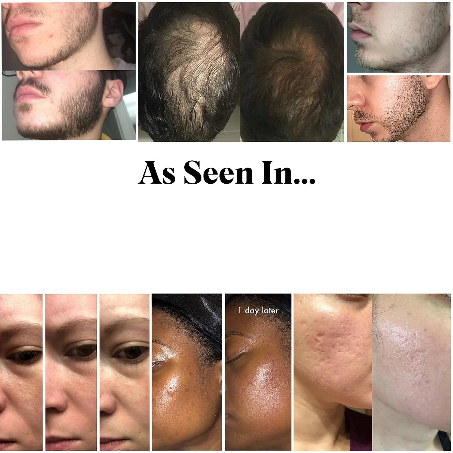 540-Needle Derma Roller — Microneedling for Face & Hair