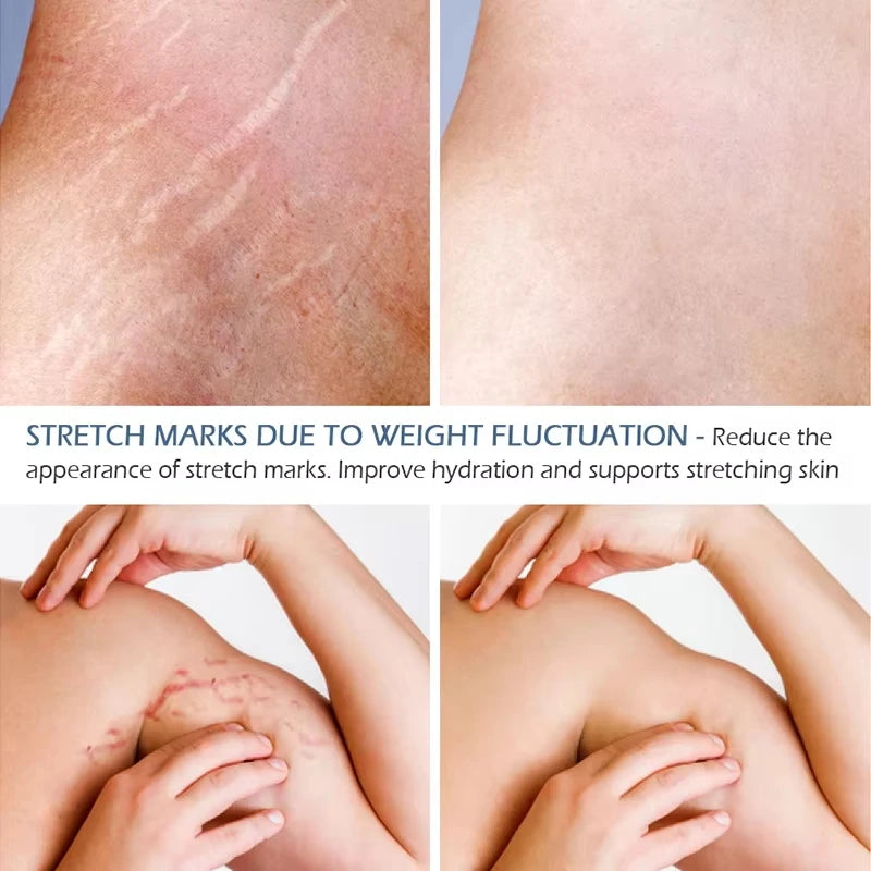 Snail Removes Stretch Mark Cream — Postpartum Firming, Anti-Aging & Wrinkle Repair Body Cream 60g