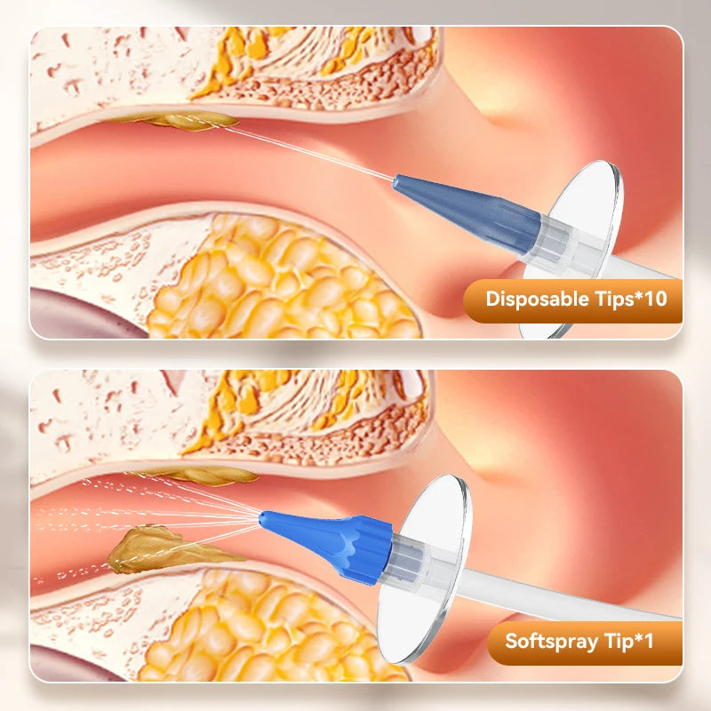 Ear Wax Removal Kit — Manual Ear Irrigation Flushing System with 10 Disposable Tips