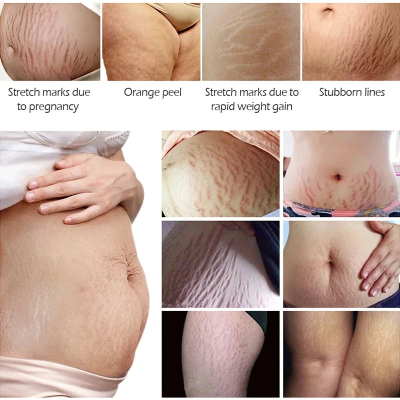 Snail Removes Stretch Mark Cream — Postpartum Firming, Anti-Aging & Wrinkle Repair Body Cream 60g