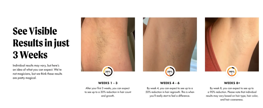 IPL Laser Hair Removal Device with Ice Cooling