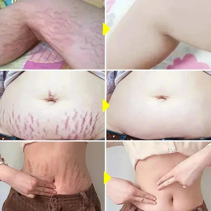 Stretch Marks Permanent Removal Cream — Repair, Firming & Skin Elasticity Body Cream 40g