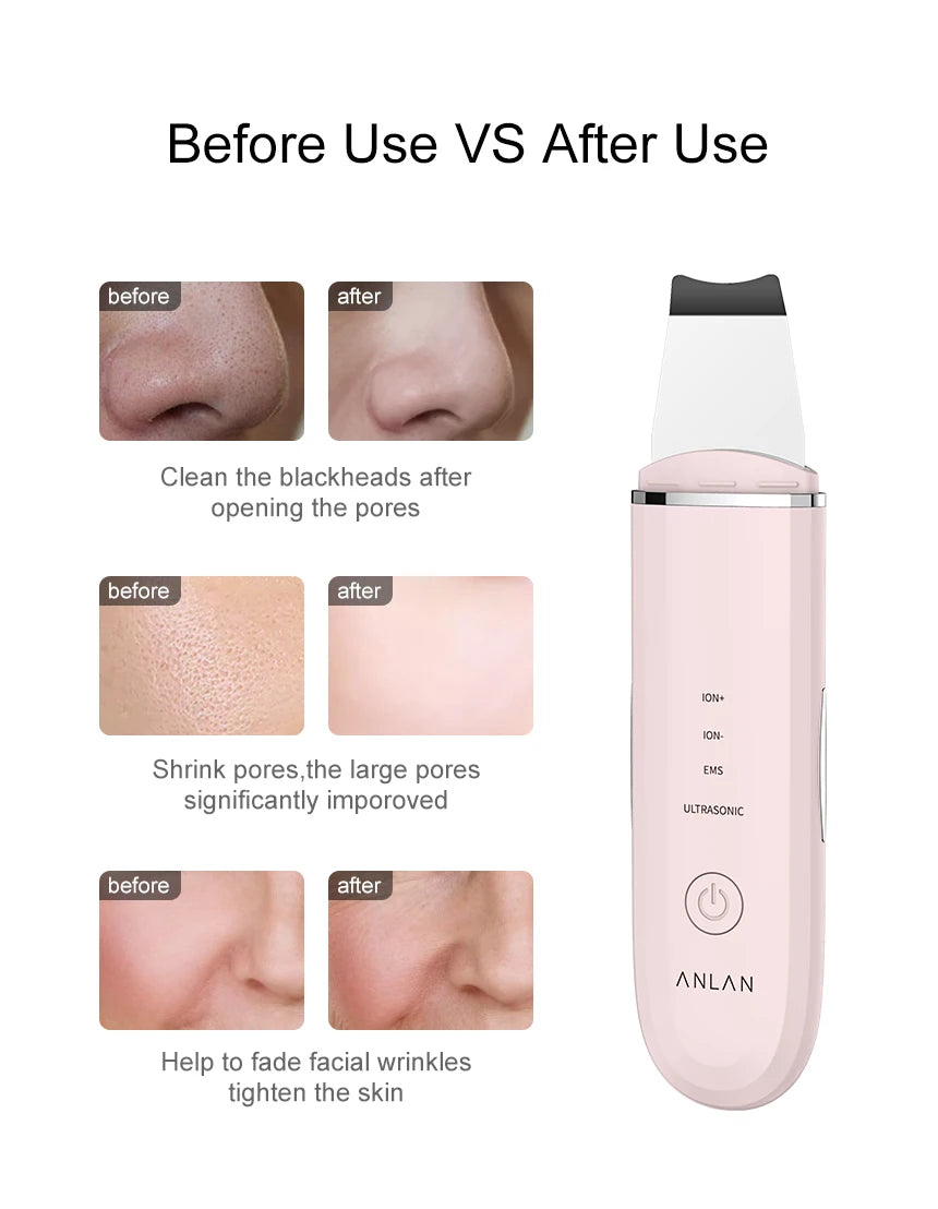 ANLAN Ultrasonic Skin Scrubber – 4-Mode Facial Pore Cleansing Spatula with Microcurrent Lifting