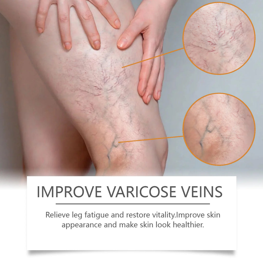 Varicose Veins Relief Cream — Soothing Leg Comfort & Skin Care (60g / 120g / 180g)