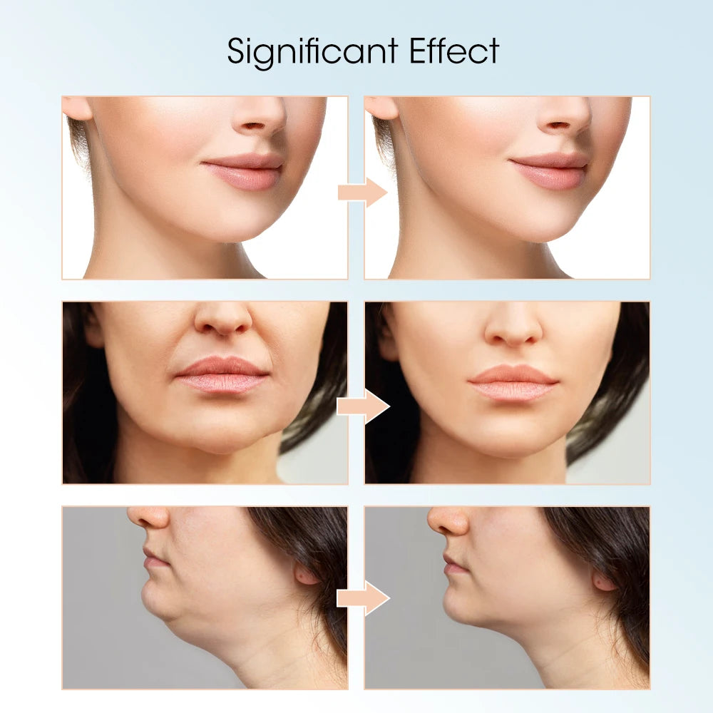 Hailicare V-Face Lifting Massager – Rechargeable Facial Slimming Device with Remote Control