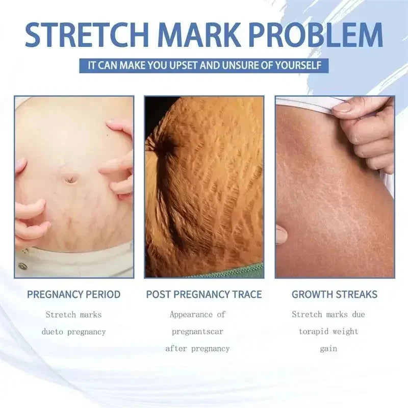 Stretch Marks Permanent Removal Cream — Repair, Firming & Skin Elasticity Body Cream 40g
