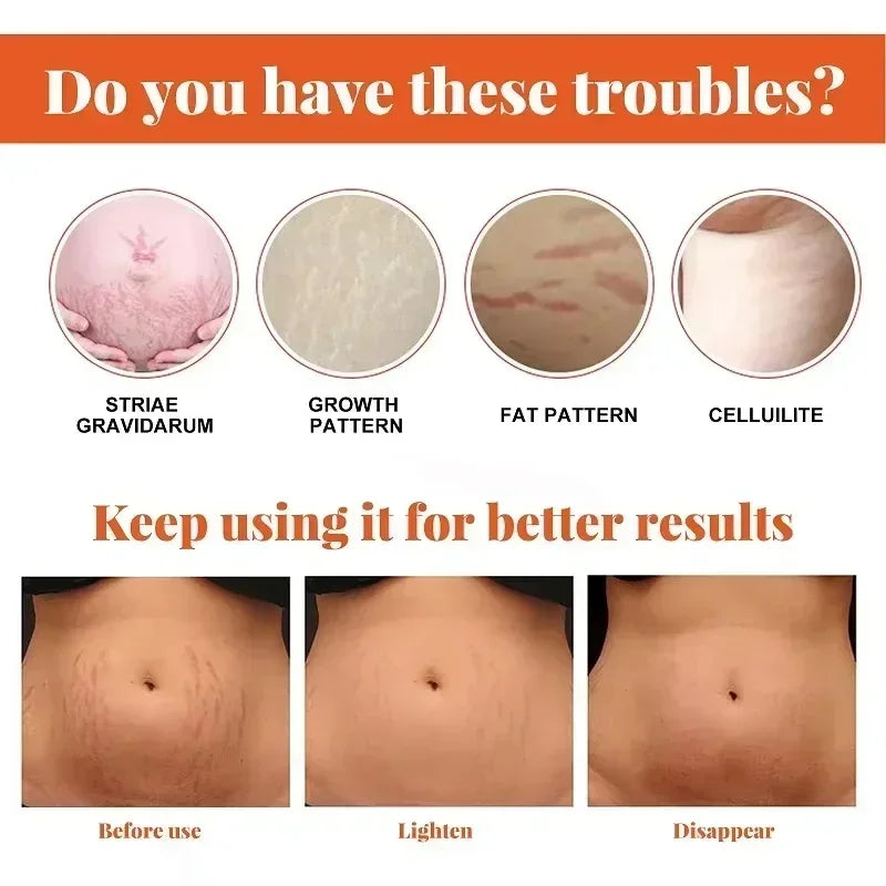 Stretch Mark Vanishing Cream — Buttock, Breast & Body Mark Repair, Firming Maternity Skin Care