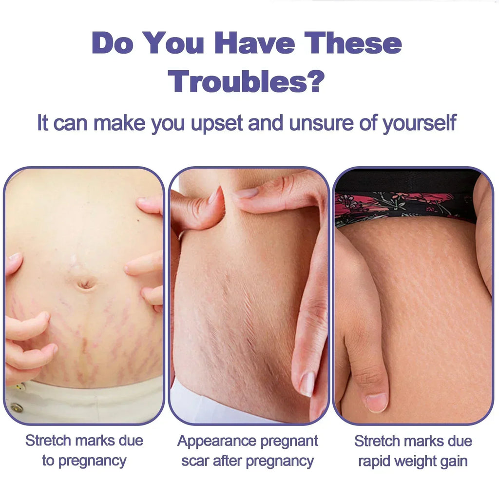 Stretch Mark Vanishing Cream — Buttock, Breast & Body Mark Repair, Firming Maternity Skin Care