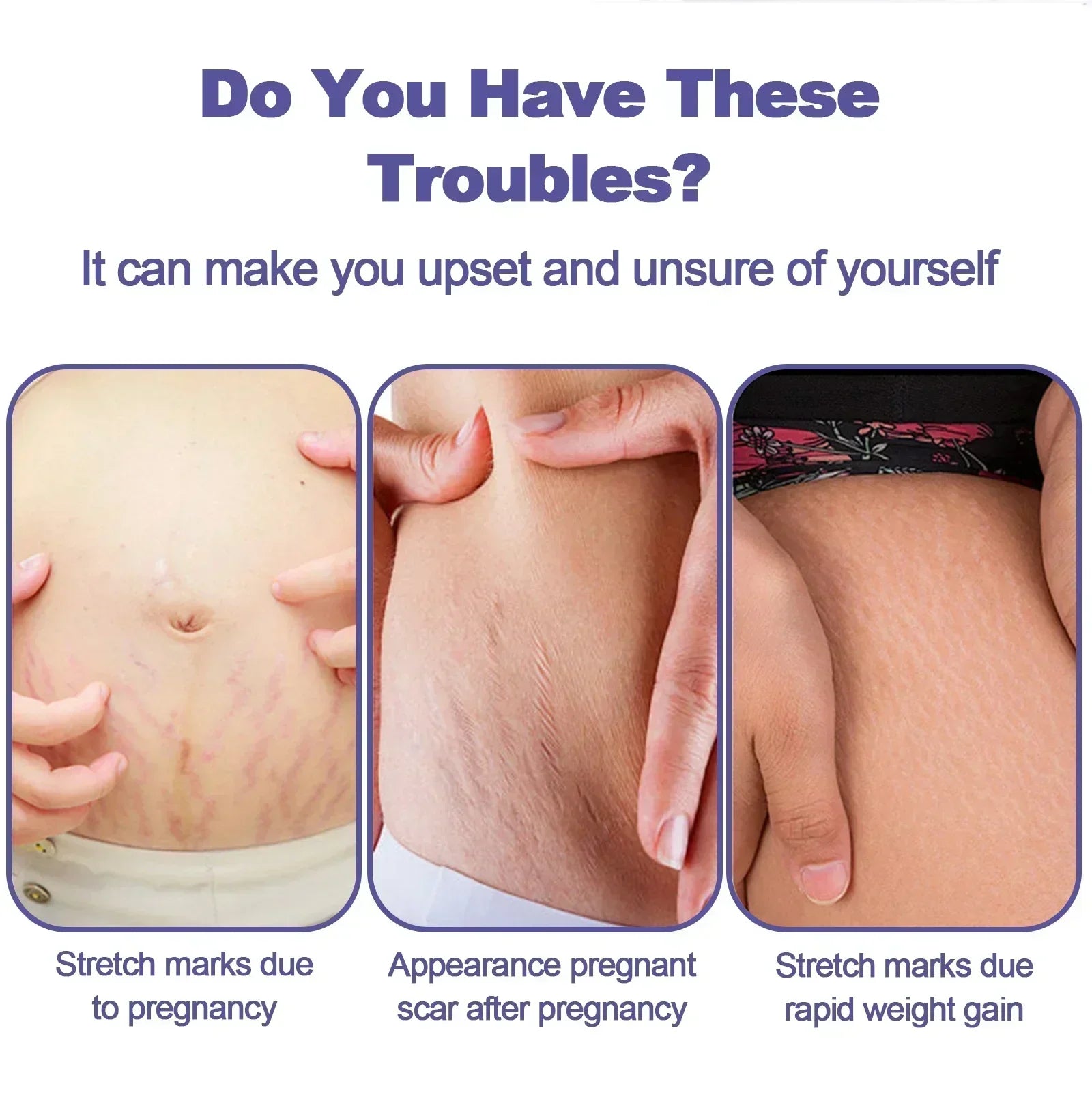 Stretch Mark Vanishing Cream — Buttock, Breast & Body Mark Repair, Firming Maternity Skin Care
