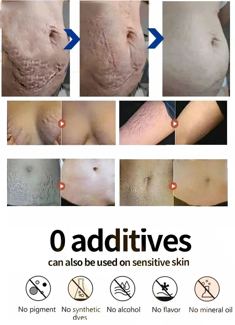 Stretch Marks Treatment & Repair Body Oil — Anti-Wrinkle Skin Care Oil for Maternity & Postpartum