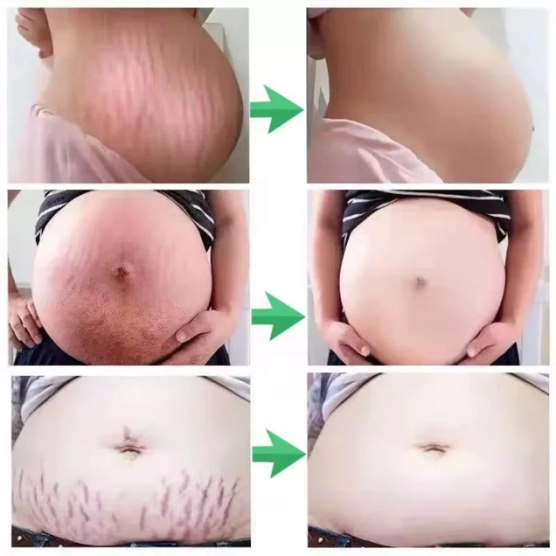 Snail Removes Stretch Mark Cream — Postpartum Firming, Anti-Aging & Wrinkle Repair Body Cream 60g