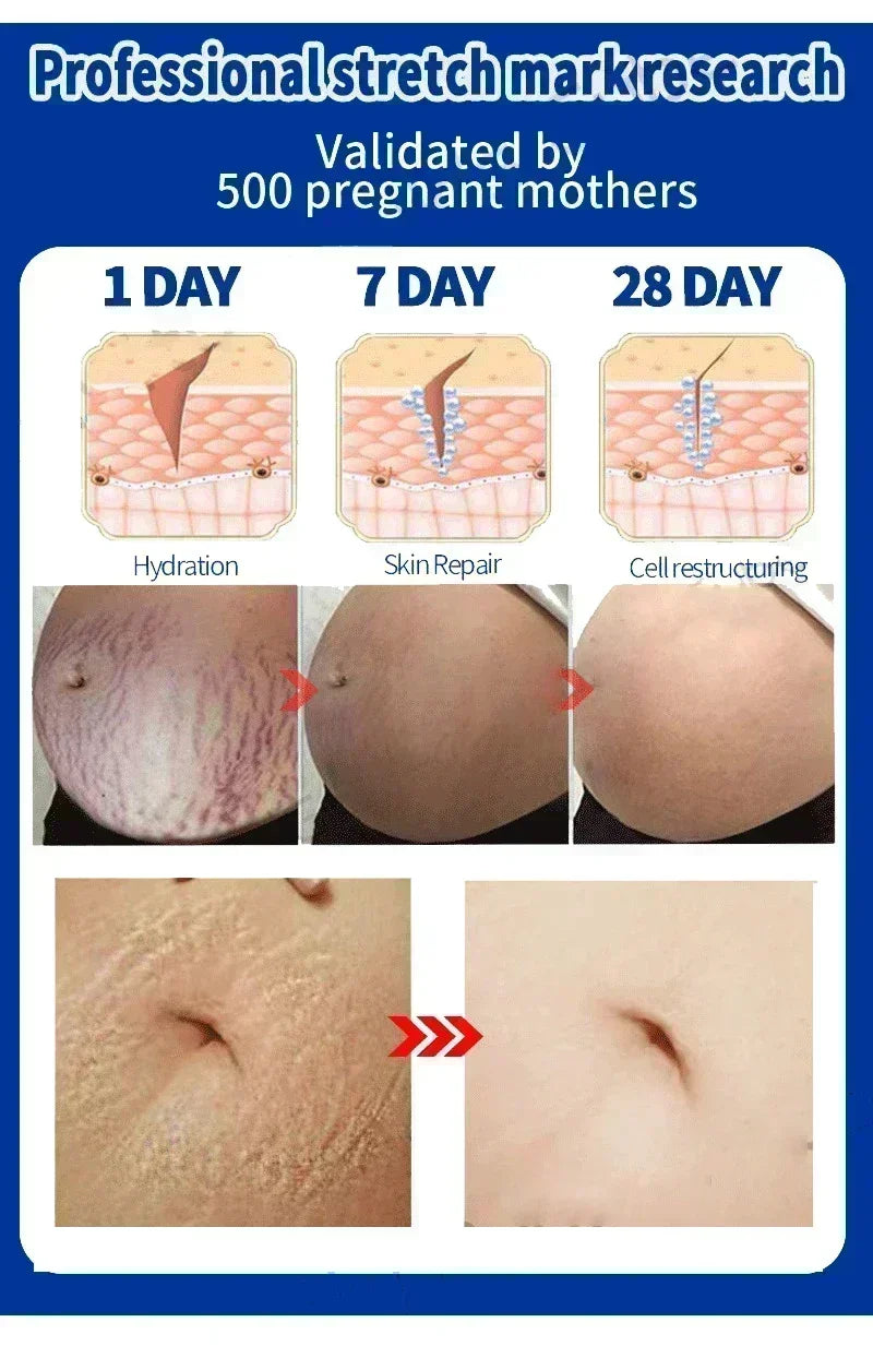 Stretch Marks Treatment & Repair Body Oil — Anti-Wrinkle Skin Care Oil for Maternity & Postpartum